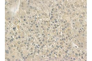 ABIN6265458 and ABIN6272741 at 1/100 staining human hepatocellular carcinoma by IHC-P.