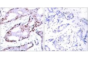 Immunohistochemistry analysis of paraffin-embedded human breast carcinoma tissue, using c-Jun (Ab-73) Antibody. (C-JUN 抗体  (AA 40-89))