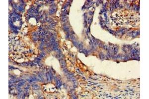 Immunohistochemistry of paraffin-embedded human colon cancer using ABIN7158800 at dilution of 1:100 (SCARB2 抗体  (AA 47-128))