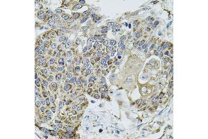 Immunohistochemistry of paraffin-embedded human lung cancer using VEPH1 antibody. (VEPH1 抗体  (AA 448-547))