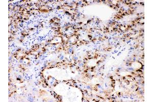 CYP3A4 was detected in paraffin-embedded sections of human liver cancer tissues using rabbit anti- CYP3A4 Antigen Affinity purified polyclonal antibody (Catalog # ) at 1 µg/mL. (CYP3A4 抗体  (Middle Region))