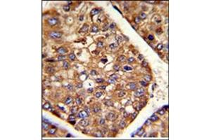 AP17615PU-N P4HB antibody staining of Formalin-Fixed and paraffin-Embedded Human hepatocarcinoma using peroxidase-conjugated to the secondary antibody, followed by DAB staining.