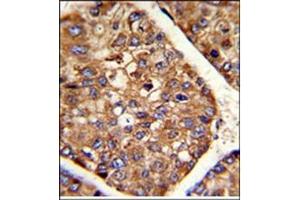 AP17615PU-N P4HB antibody staining of Formalin-Fixed and paraffin-Embedded Human hepatocarcinoma using peroxidase-conjugated to the secondary antibody, followed by DAB staining. (P4HB 抗体  (C-Term))