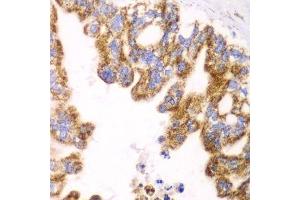 Immunohistochemistry of paraffin-embedded human liver cancer using GLUD2 antibody. (GLUD2 抗体  (AA 319-558))