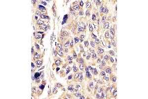 (ABIN390393 and ABIN2840785) staining AGXT in Human hepatic carcinoma tissue sections by Immunohistochemistry (IHC-P - paraformaldehyde-fixed, paraffin-embedded sections). (AGXT 抗体  (AA 96-125))