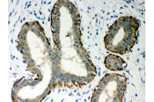 Anti- MASPIN Picoband antibody, IHC(P) IHC(P): Human Mammary Cancer Tissue (SERPINB5 抗体  (AA 1-350))