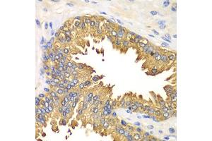 Immunohistochemistry of paraffin-embedded human prostate using DDX58 antibody (ABIN5970201) at dilution of 1/100 (40x lens). (DDX58 抗体)