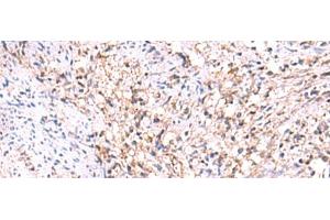 Immunohistochemistry of paraffin-embedded Human cervical cancer tissue using MANSC1 Polyclonal Antibody at dilution of 1:105(x200) (MANSC1 抗体)