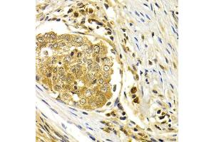 Immunohistochemistry of paraffin-embedded human esophageal cancer using CDK7 antibody (ABIN1871743) at dilution of 1:200 (40x lens). (CDK7 抗体)