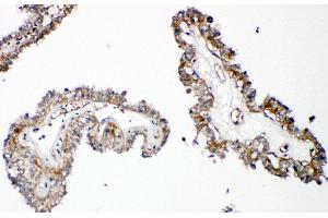 Anti-Parathyroid Hormone Receptor 1 antibody, IHC(P) IHC(P): Human Thyroid Cancer Tissue (PTH1R 抗体  (C-Term))