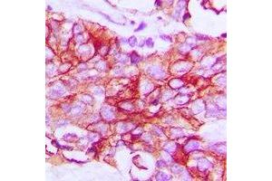 Immunohistochemical analysis of IFNGR1 staining in human breast cancer formalin fixed paraffin embedded tissue section. (IFNGR1 抗体  (C-Term))