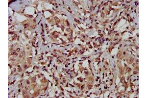 IHC image of ABIN7149946 diluted at 1:500 and staining in paraffin-embedded human liver cancer performed on a Leica BondTM system. (TFB1M 抗体  (AA 59-194))