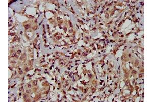 IHC image of ABIN7149946 diluted at 1:500 and staining in paraffin-embedded human liver cancer performed on a Leica BondTM system.