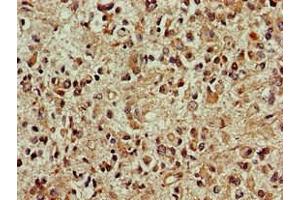 Immunohistochemistry of paraffin-embedded human glioma using ABIN7149696 at dilution of 1:100 (DCK 抗体  (AA 1-79))