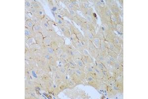 Immunohistochemistry of paraffin-embedded human liver cancer using CEACAM7 antibody (ABIN5974489) at dilution of 1/100 (40x lens). (CEACAM7 抗体)