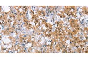 Immunohistochemistry of paraffin-embedded Human thyroid cancer tissue using MLH1 Polyclonal Antibody at dilution 1:65 (MLH1 抗体)