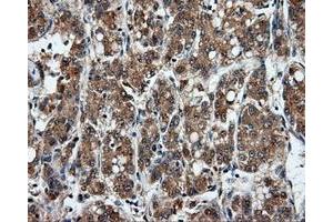 Immunohistochemical staining of paraffin-embedded Carcinoma of liver tissue using anti-MSMB mouse monoclonal antibody. (MSMB 抗体)