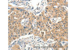 Immunohistochemistry of Human lung cancer using SLC11A2 Polyclonal Antibody at dilution of 1:65 (SLC11A2 抗体)