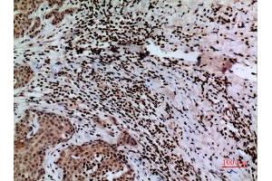 Immunohistochemistry (IHC) analysis of paraffin-embedded Human Mammary Cancer, antibody was diluted at 1:100.