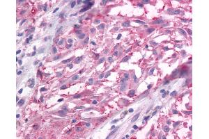 Anti-GRM3 / MGLUR3 antibody IHC of human Skin, Melanoma. (Metabotropic Glutamate Receptor 3 抗体  (N-Term))