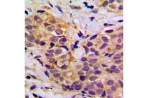 Immunohistochemical analysis of MRPL11 staining in human breast cancer formalin fixed paraffin embedded tissue section. (MRPL11 抗体  (Center))