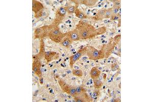Formalin-fixed and paraffin-embedded human hepatocarcinoma reacted with GCG Antibody (N-term), which was peroxidase-conjugated to the secondary antibody, followed by DAB staining. (Glucagon 抗体  (N-Term))