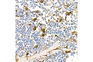 Immunohistochemistry of paraffin-embedded Human Hodgkin lymphoma using Fascin/FSCN1 antibody (ABIN7267142) at dilution of 1:100 (40x lens). (Fascin 抗体)