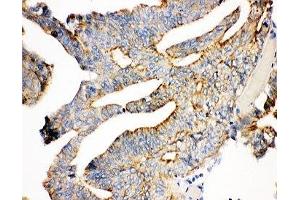 IHC-P: Plakoglobin antibody testing of human intestine cancer tissue (JUP 抗体  (AA 556-745))