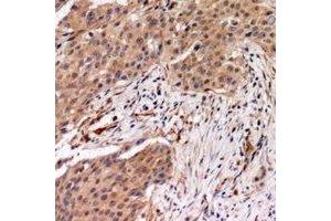 Immunohistochemical analysis of MYPT1 (pT696) staining in human breast cancer formalin fixed paraffin embedded tissue section. (PPP1R12A 抗体  (pSer696))