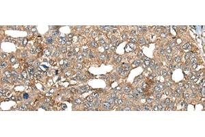 Immunohistochemistry of paraffin-embedded Human liver cancer tissue using BRD9 Polyclonal Antibody at dilution of 1:80(x200) (BRD9 抗体)