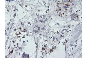 Immunohistochemical staining of paraffin-embedded Adenocarcinoma of Human breast tissue using anti-SDS mouse monoclonal antibody. (serine Dehydratase 抗体)