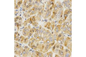 Immunohistochemistry of paraffin-embedded human liver cancer using TPM2 antibody (ABIN5971583) at dilution of 1/200 (40x lens). (TPM2 抗体)