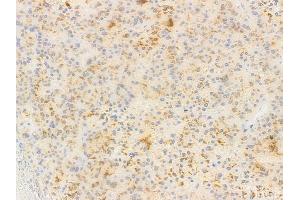 ABIN7097022 and ABIN7101089 at 1/100 staining human hepatocellular carcinoma by IHC-P.
