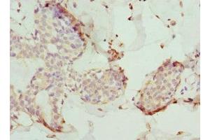 Immunohistochemistry of paraffin-embedded human breast cancer using ABIN7173557 at dilution of 1:100 (Tropomodulin 4 抗体  (AA 1-345))