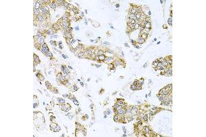 Immunohistochemistry of paraffin-embedded human gastric cancer using ALKBH8 antibody (ABIN5974297) at dilution of 1/100 (40x lens). (ALKBH8 抗体)