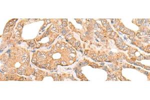 Immunohistochemistry of paraffin-embedded Human thyroid cancer tissue using DEF8 Polyclonal Antibody at dilution of 1:25(x200) (DEF8 抗体)