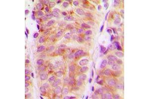 Immunohistochemical analysis of ARHGEF10 staining in human breast cancer formalin fixed paraffin embedded tissue section. (ARHGEF10 抗体  (Center))