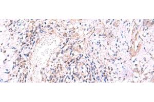 Immunohistochemistry of paraffin-embedded Human cervical cancer tissue using MRPS24 Polyclonal Antibody at dilution of 1:90(x200) (MRPS24 抗体)