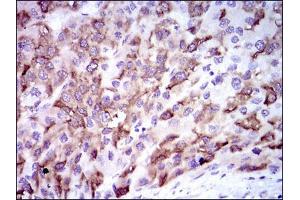 Immunohistochemical analysis of paraffin-embedded liver cancer tissues using CYP3A4 mouse mAb with DAB staining.