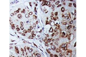 IHC-P: Lamin B1 antibody testing of human breast cancer tissue (Lamin B1 抗体  (AA 570-586))