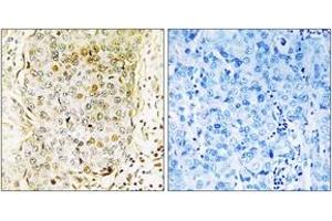 Immunohistochemistry analysis of paraffin-embedded human breast carcinoma tissue, using MLK3 (Ab-674) Antibody. (MAP3K11 抗体  (AA 640-689))