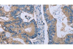 Immunohistochemistry of paraffin-embedded Human colon cancer using HYAL3 Polyclonal Antibody at dilution of 1:40 (HYAL3 抗体)