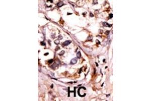 Formalin-fixed and paraffin-embedded human cancer tissue reacted with the primary antibody, which was peroxidase-conjugated to the secondary antibody, followed by AEC staining. (SYK 抗体  (pTyr525, pTyr526))
