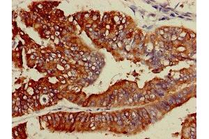 IHC image of ABIN7158511 diluted at 1:600 and staining in paraffin-embedded human endometrial cancer performed on a Leica BondTM system. (ACSL5 抗体  (AA 33-683))