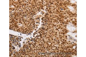 Immunohistochemistry of Human lung cancer using THOC7 Polyclonal Antibody at dilution of 1:30 (THOC7 抗体)