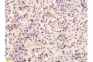 Formalin-fixed and paraffin embedded human cervical carcinoma labeled with Anti-HER2/NEU/ErbB2 Polyclonal Antibody, Unconjugated  at 1:400 followed by conjugation to the secondary antibody and DAB staining (ErbB2/Her2 抗体  (AA 1210-1255))