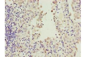 Immunohistochemistry of paraffin-embedded human lung cancer using ABIN7167244 at dilution of 1:100 (RAB2A 抗体  (AA 1-234))
