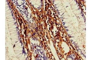 Immunohistochemistry of paraffin-embedded human colon cancer using ABIN7148281 at dilution of 1:100 (MMP13 抗体  (AA 104-471))