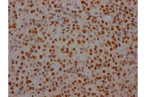 IHC image of ABIN7127805 diluted at 1:100 and staining in paraffin-embedded human glioma cancer performed on a Leica BondTM system. (Recombinant SF3B1 抗体)