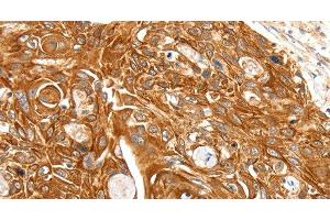 Immunohistochemistry of paraffin-embedded Human esophagus cancer using SFTPA1 Polyclonal Antibody at dilution of 1:30 (Surfactant Protein A1 抗体)
